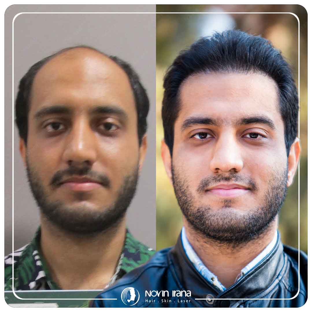 کاشت مو