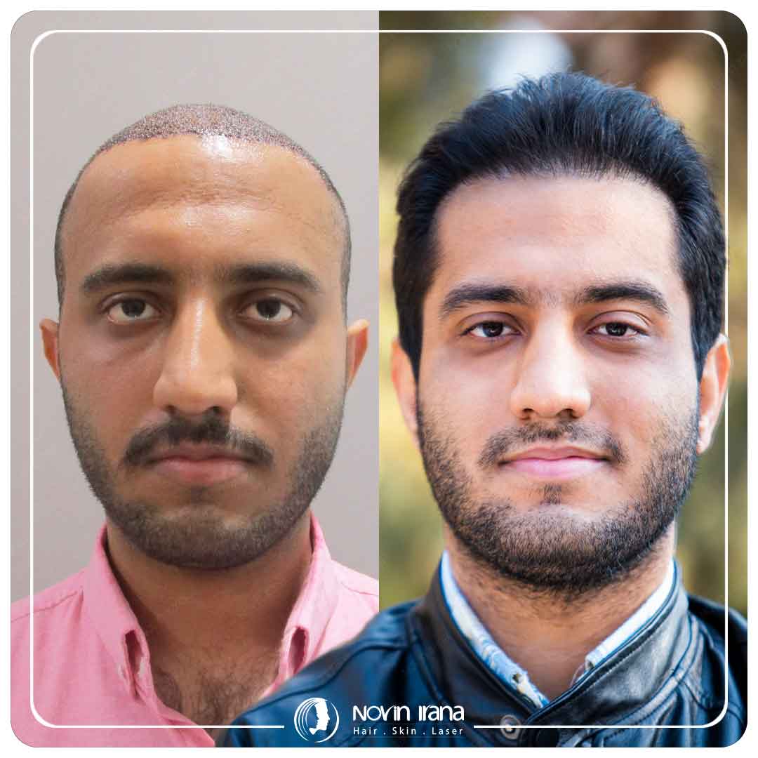 کاشت مو