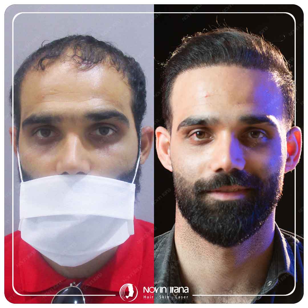 کاشت مو