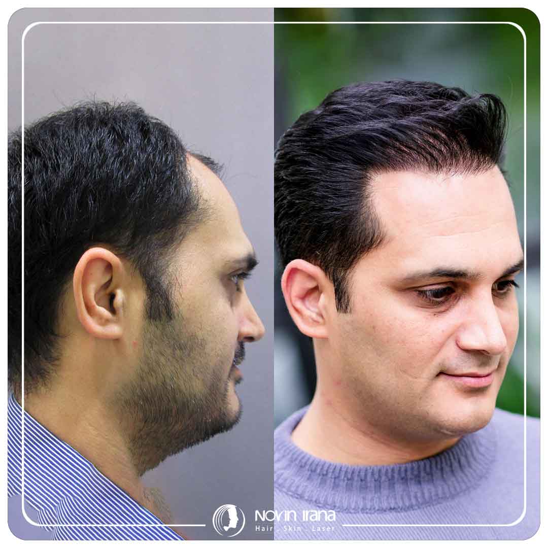 کاشت مو