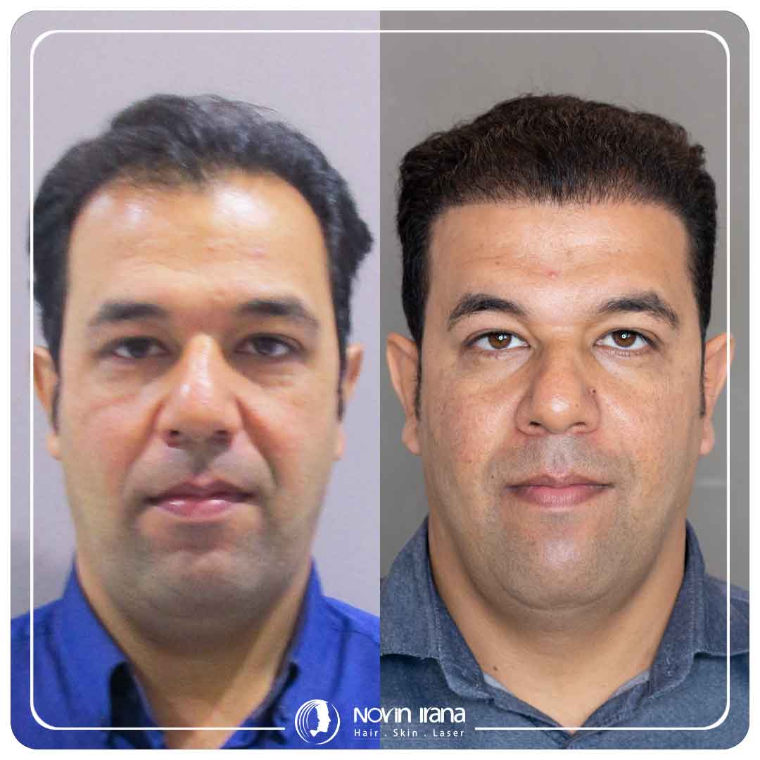 زراعة الشعر