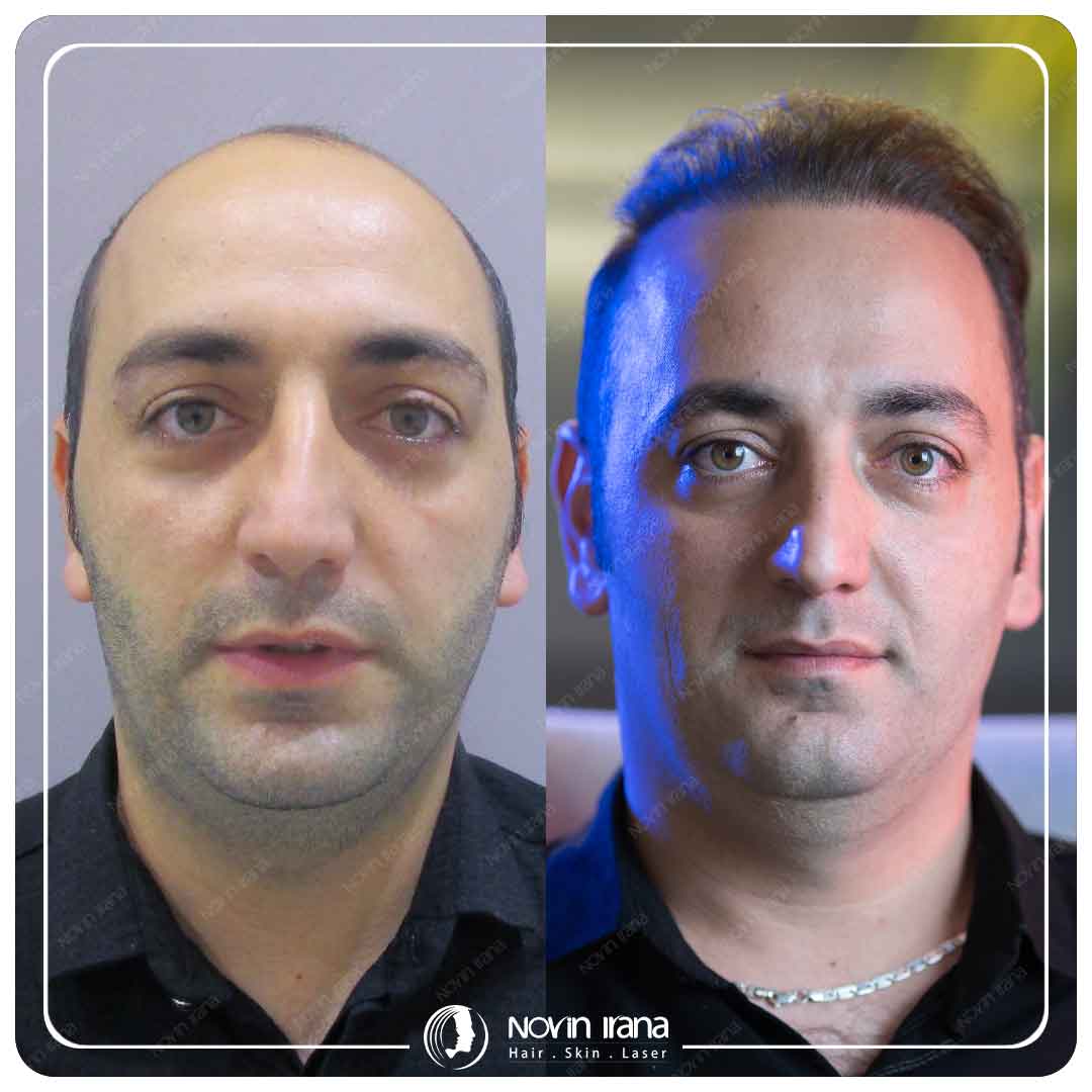 کاشت مو