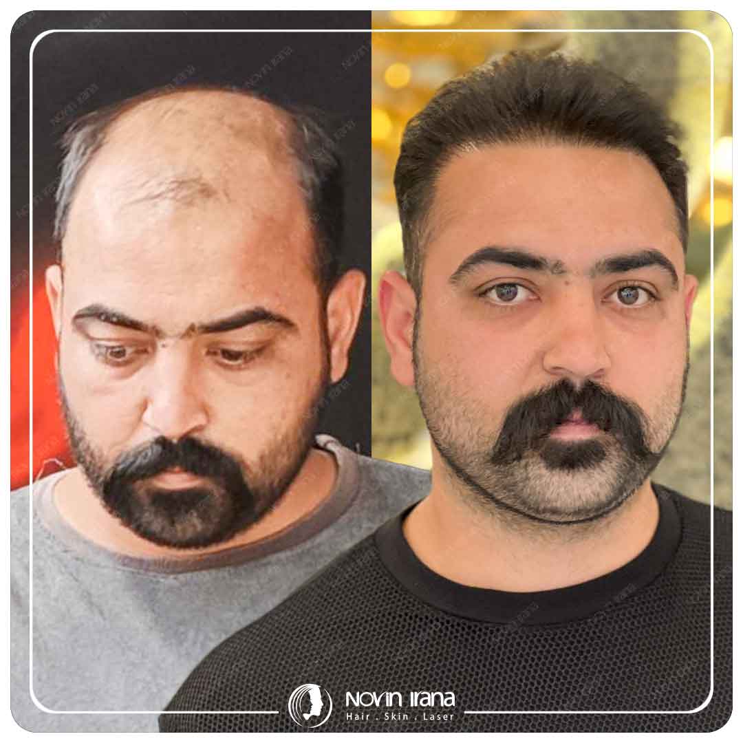کاشت مو