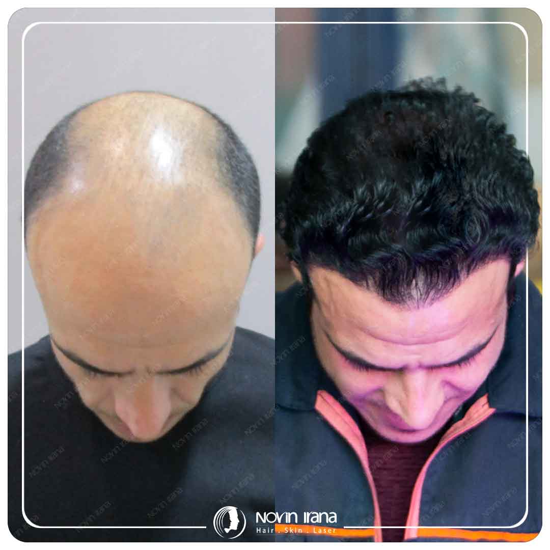 زراعة الشعر