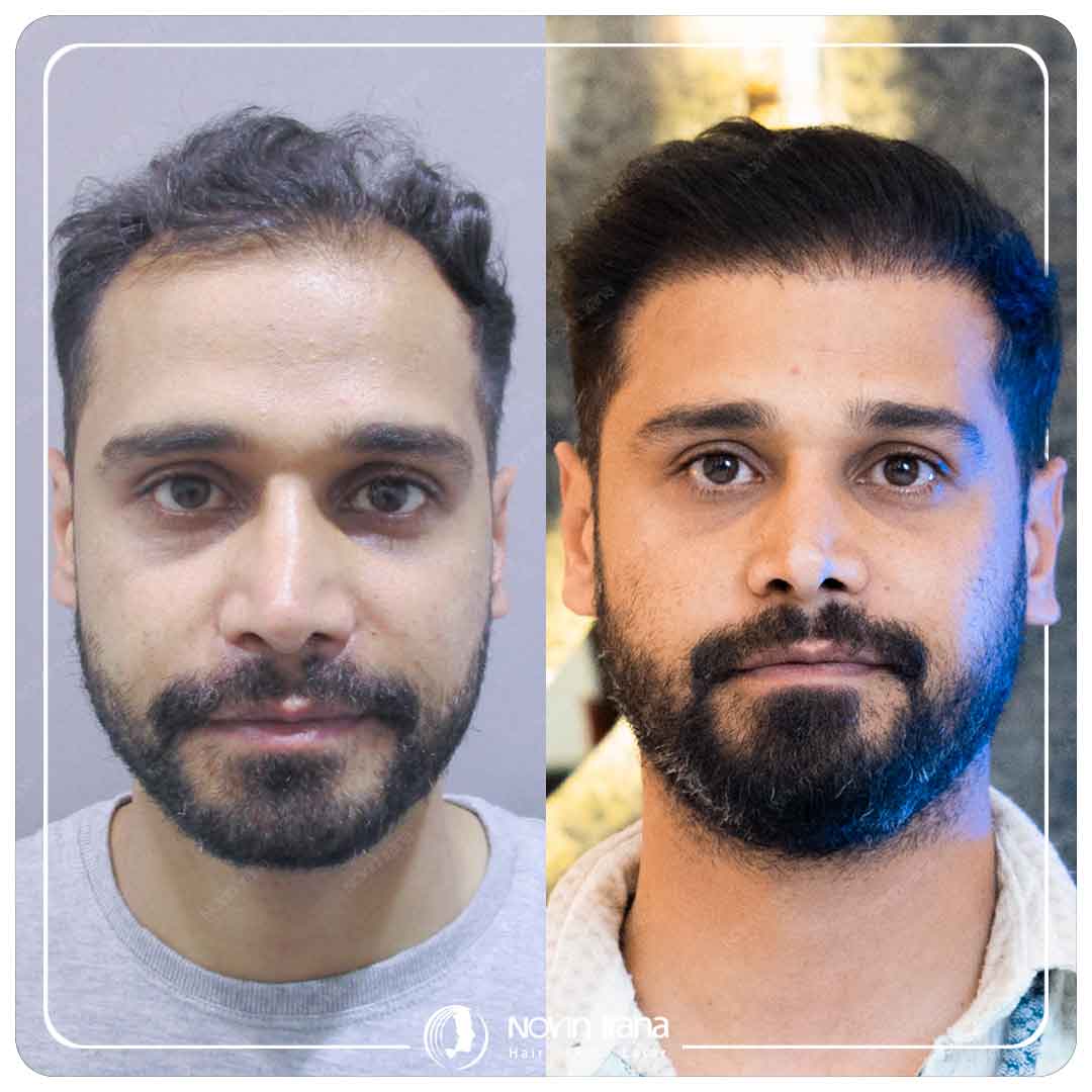 کاشت مو
