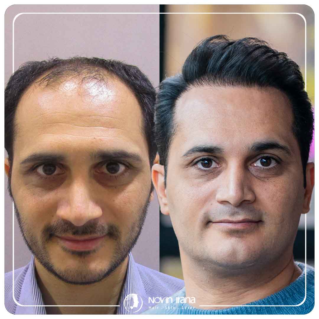 کاشت مو