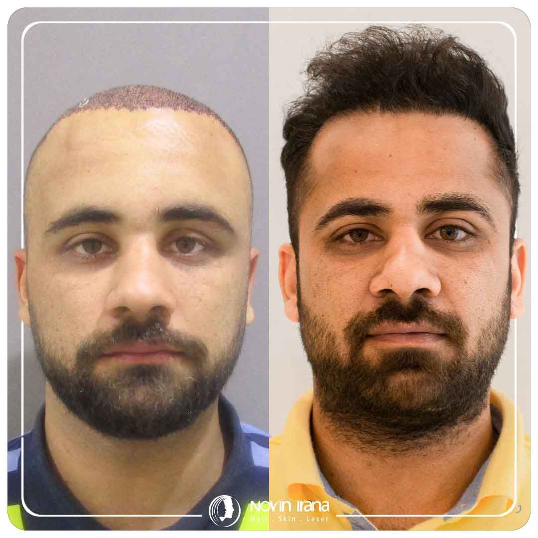 کاشت مو