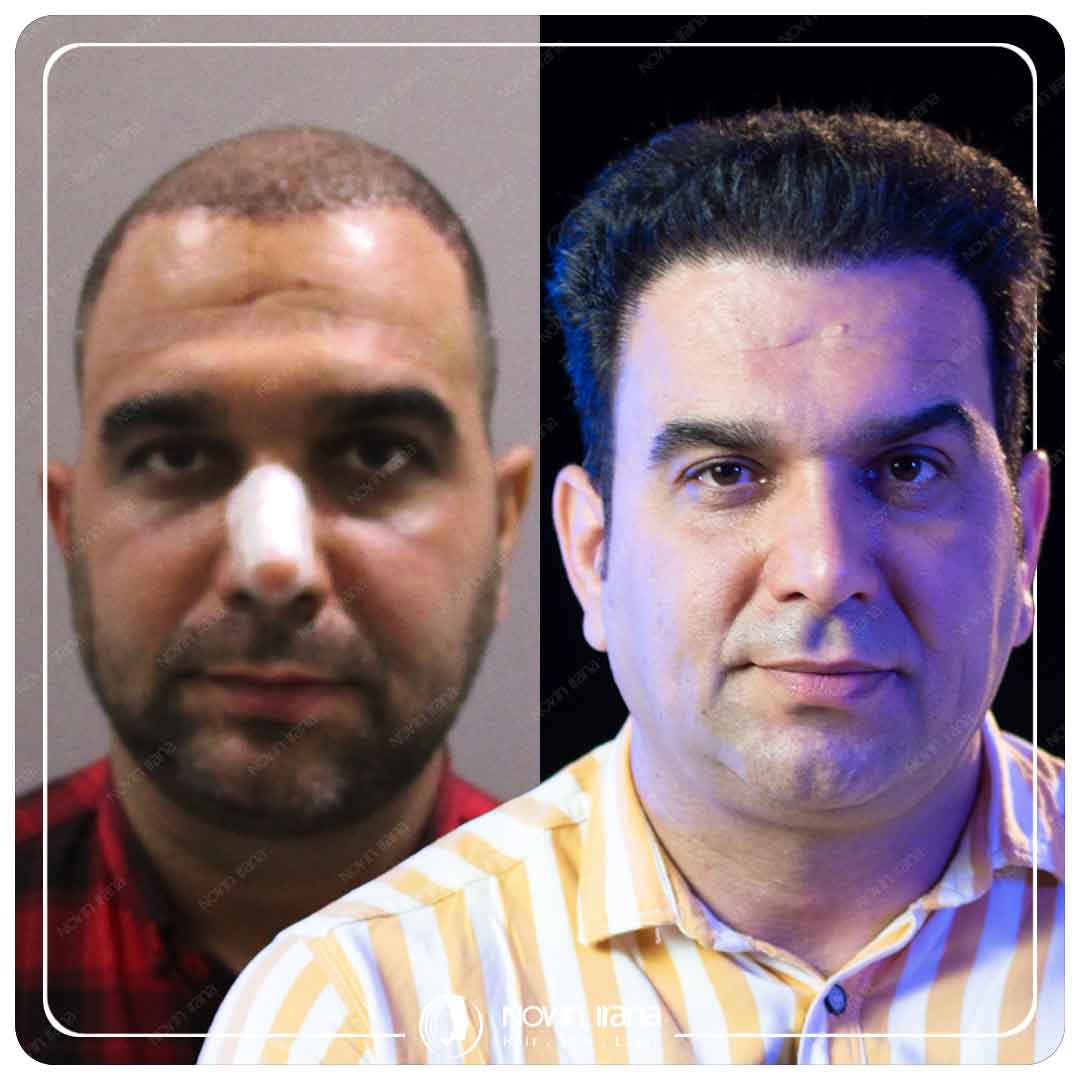کاشت مو