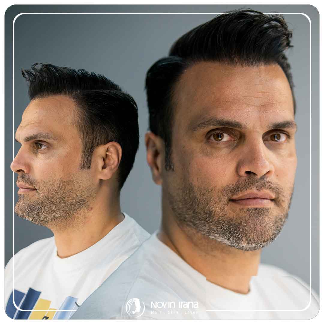 كاشت مو