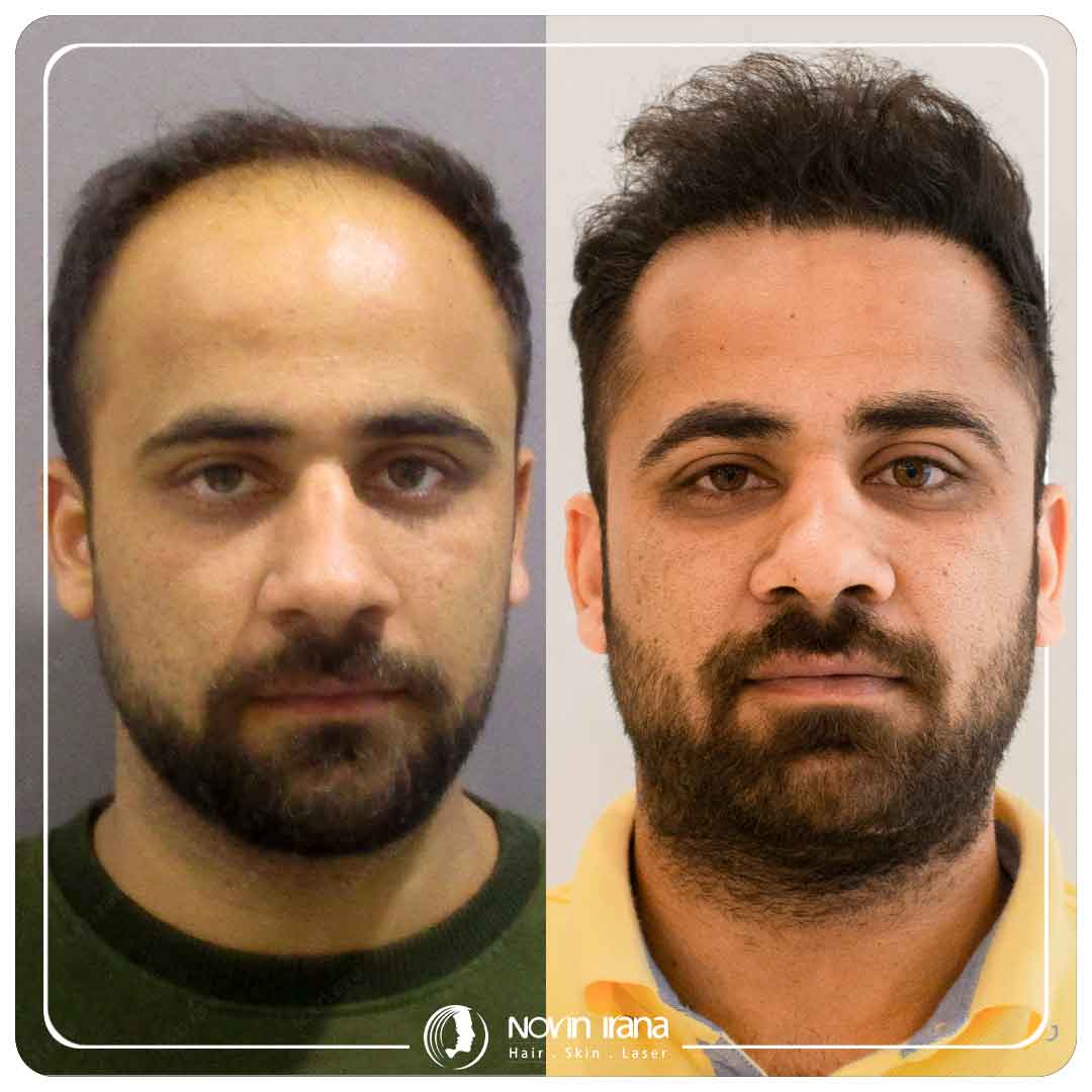 کاشت مو