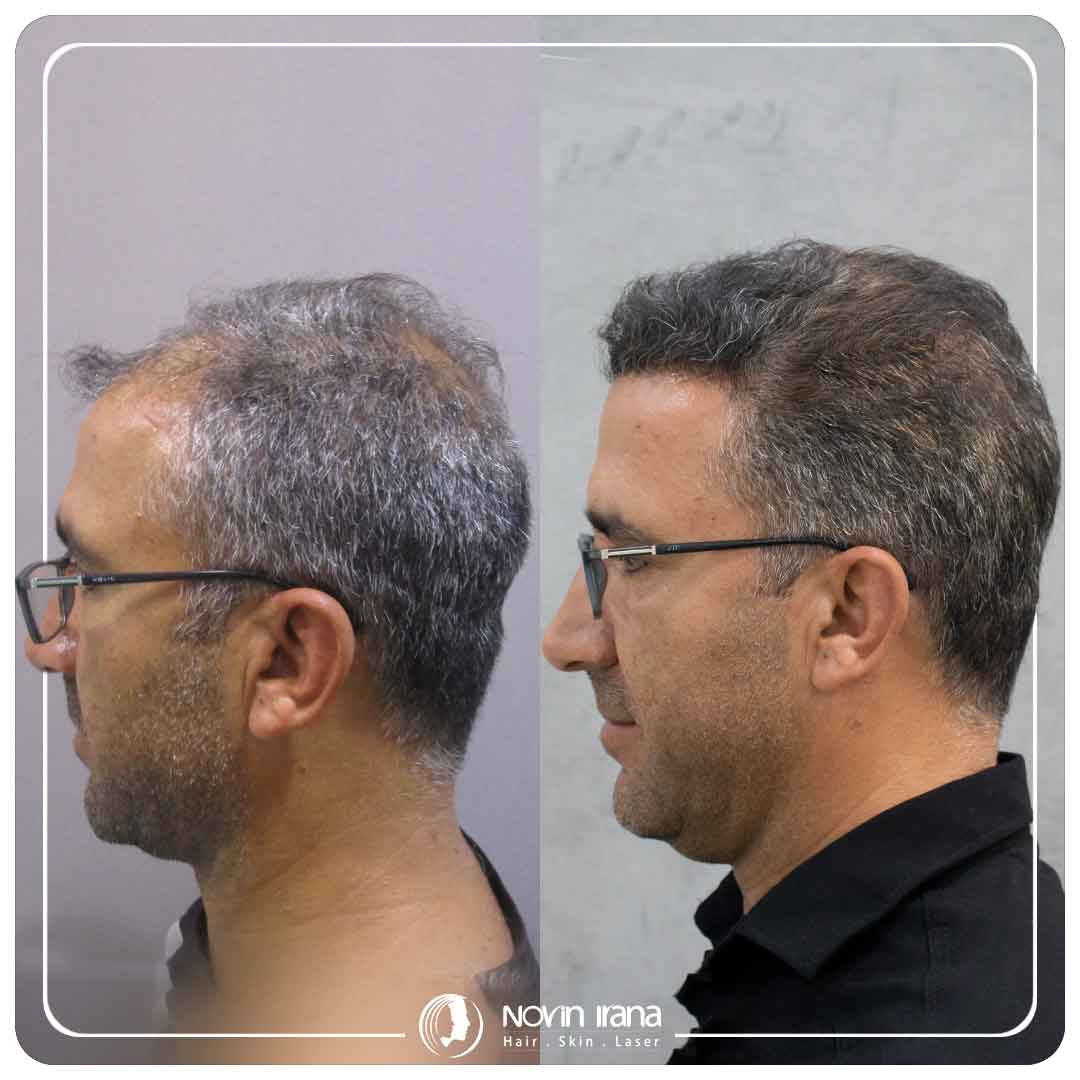 کاشت مو