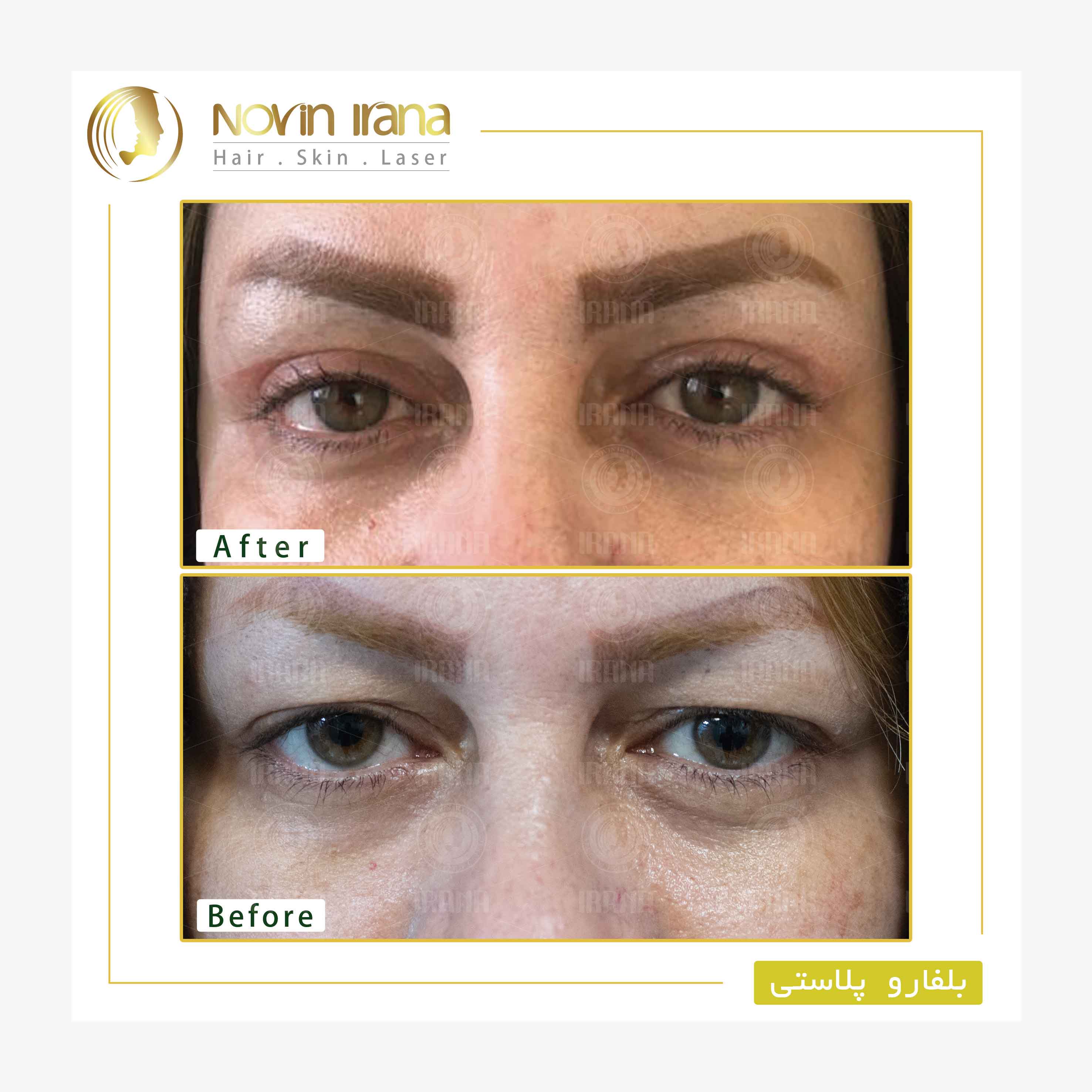 Blepharoplasty