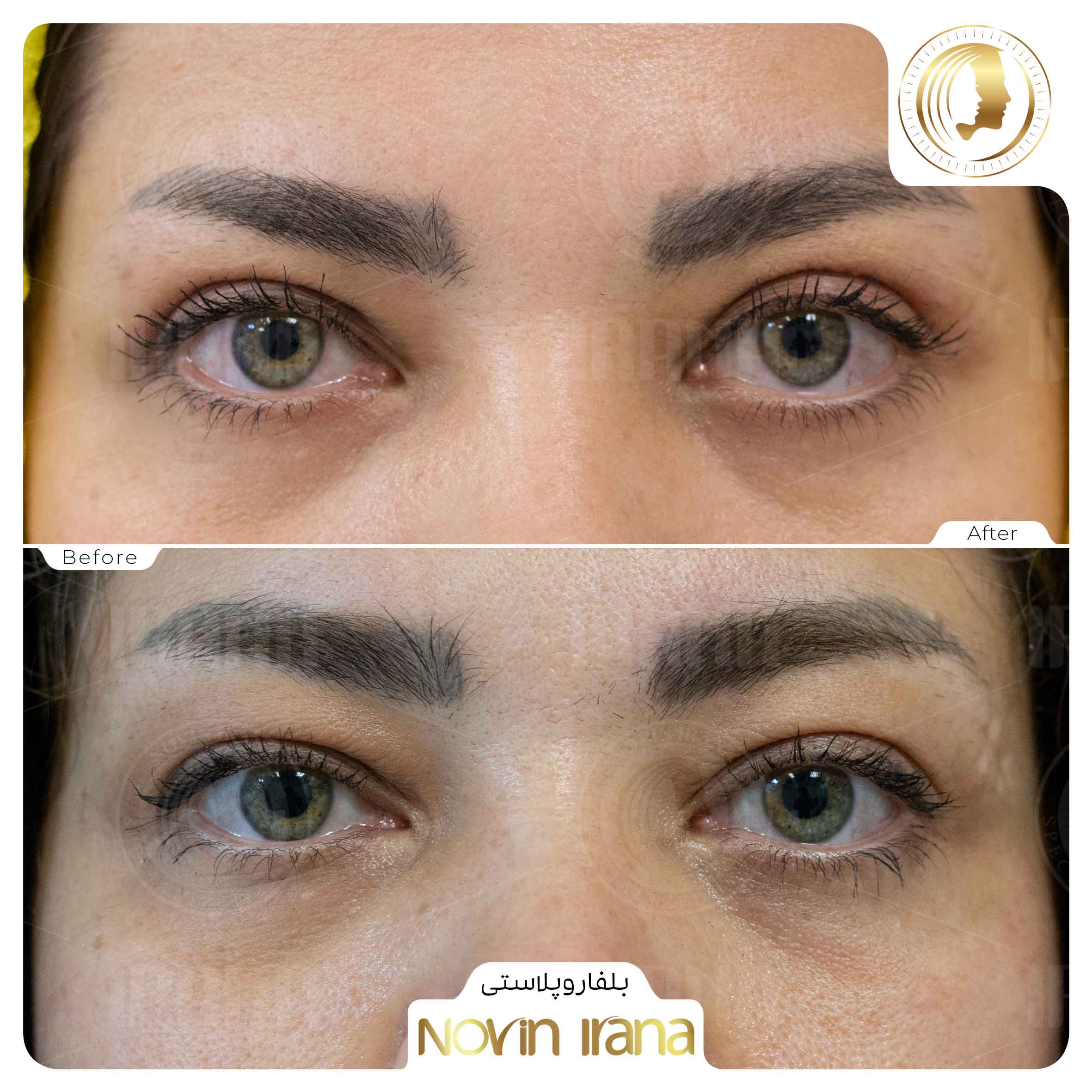 Blepharoplasty