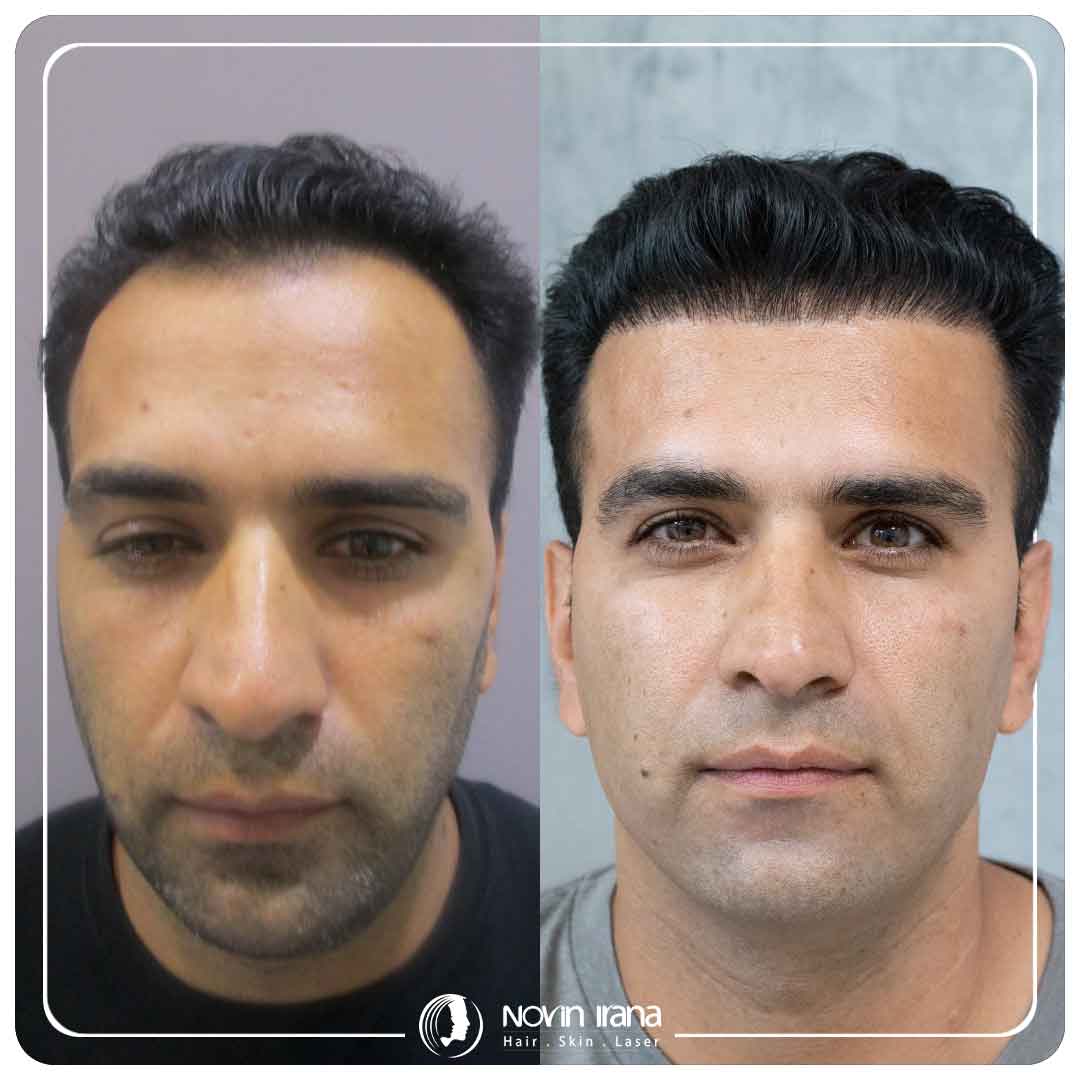کاشت مو