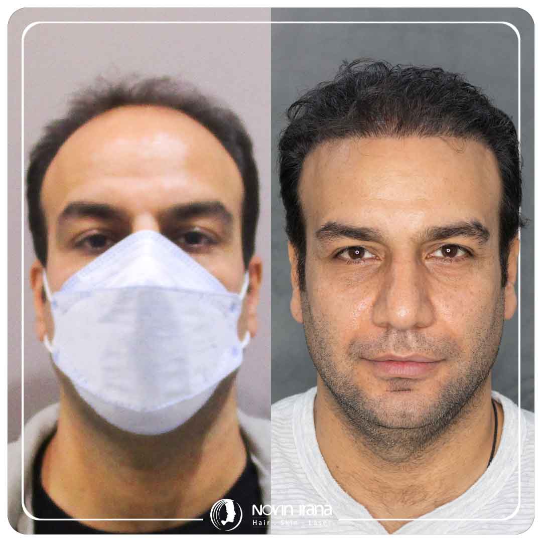 کاشت مو