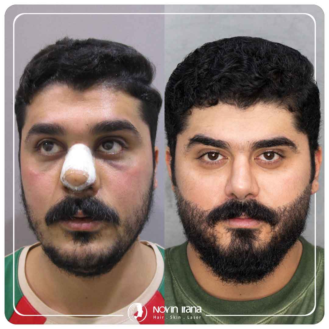 Hair Transplant