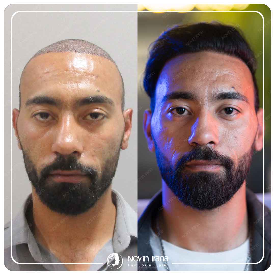 Hair Transplant