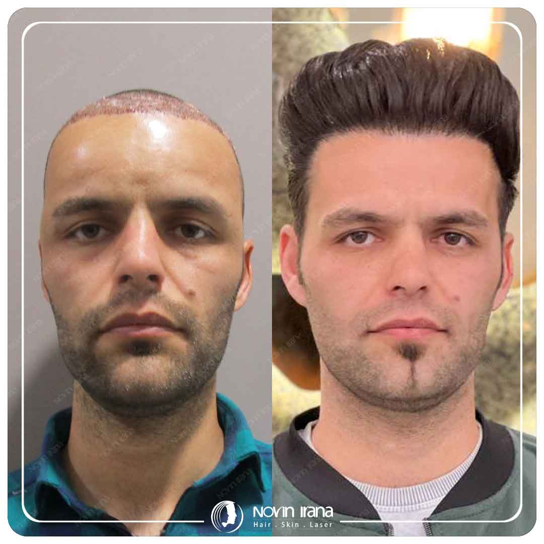 Hair Transplant
