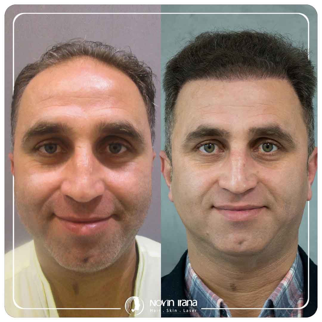کاشت مو
