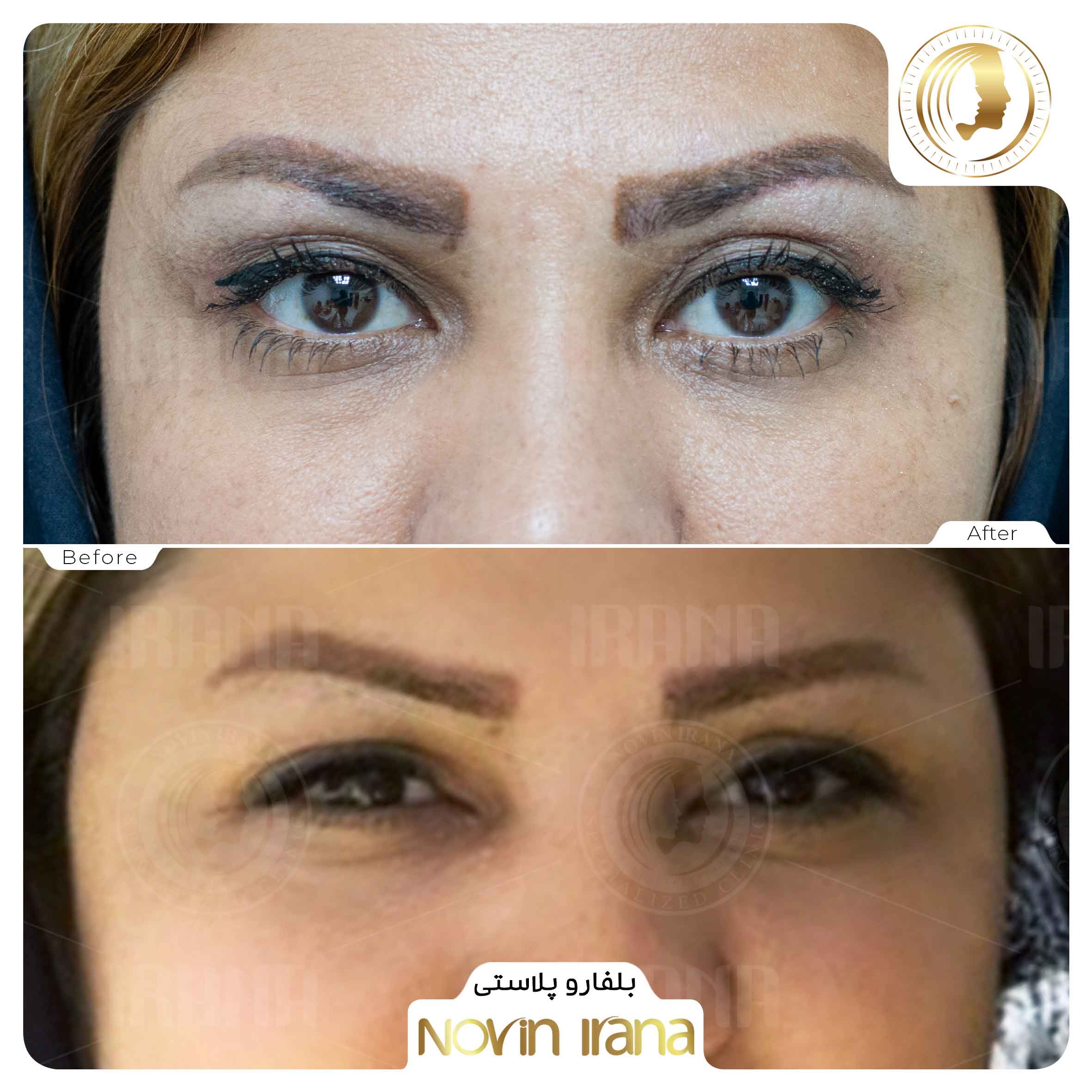 Blepharoplasty