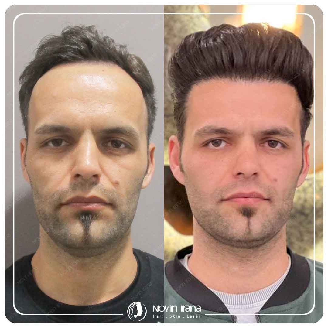 Hair Transplant