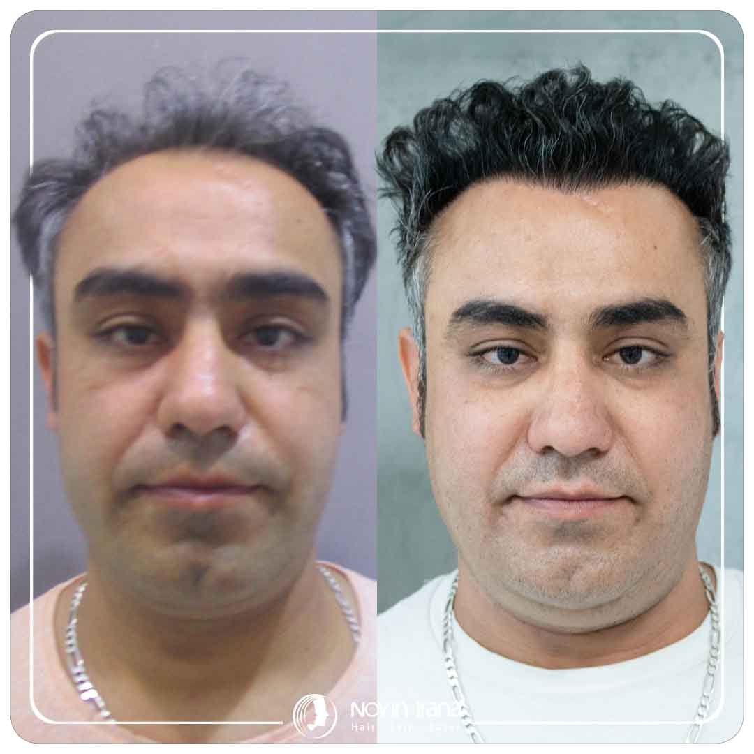 کاشت مو
