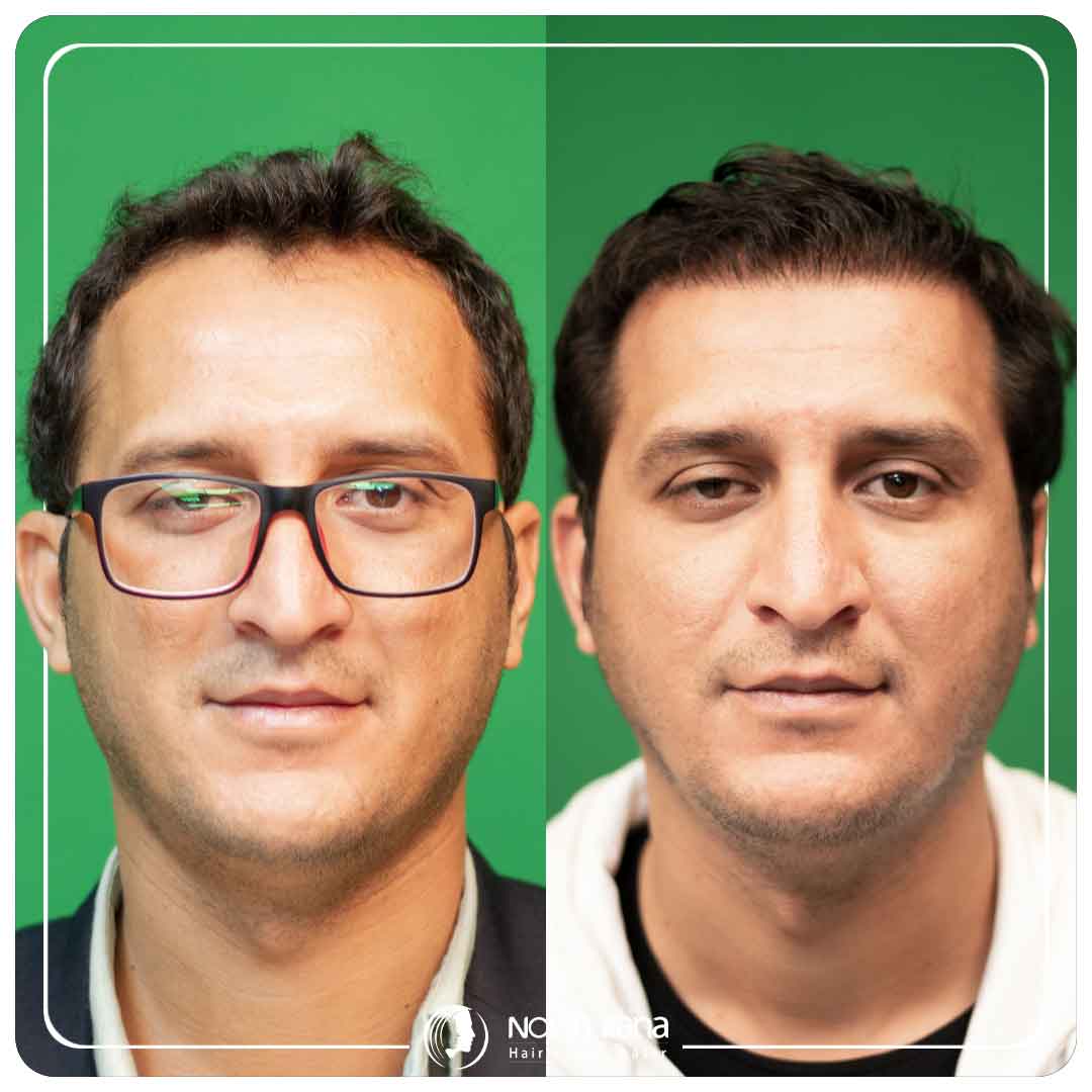 کاشت مو