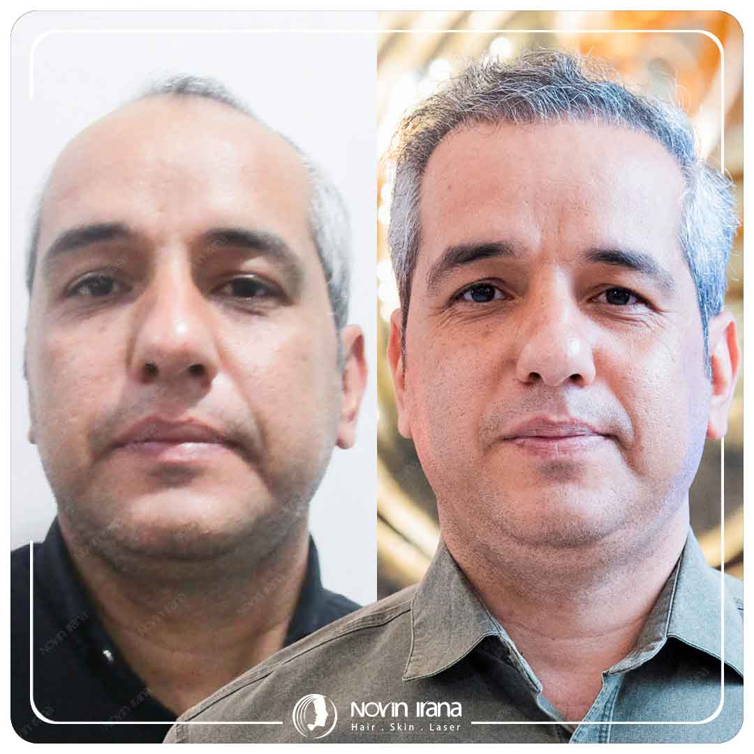 کاشت مو