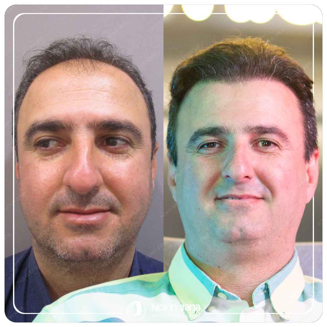 Hair Transplant