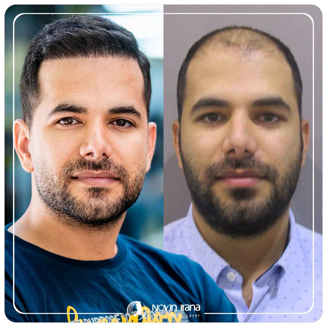 Hair Transplant