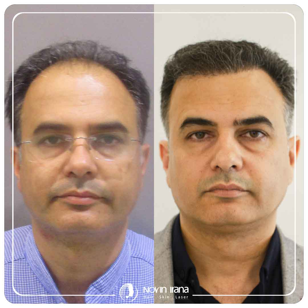 کاشت مو