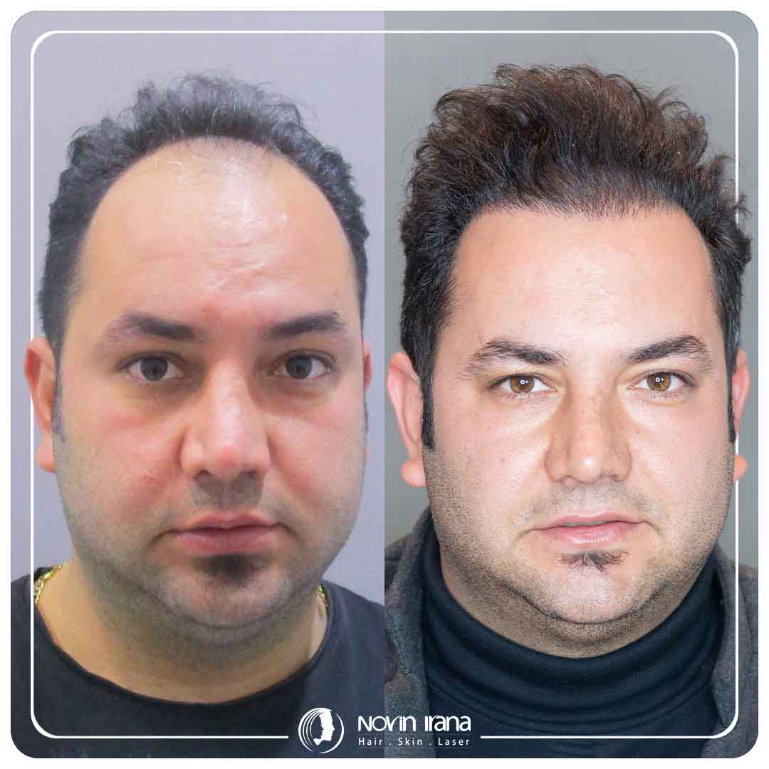Hair Transplant