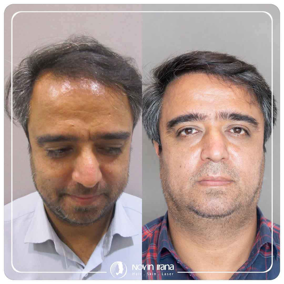 کاشت مو