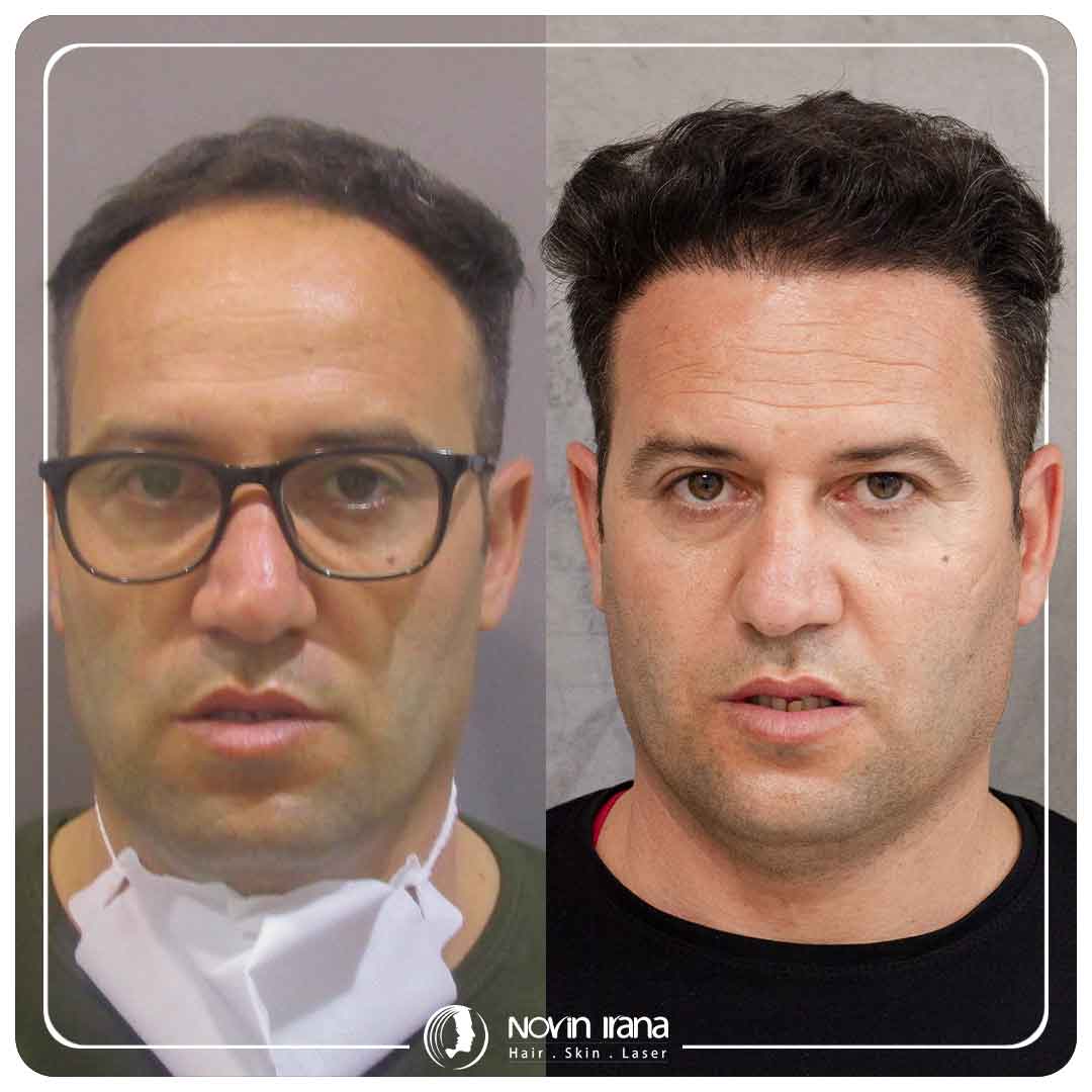 Hair Transplant