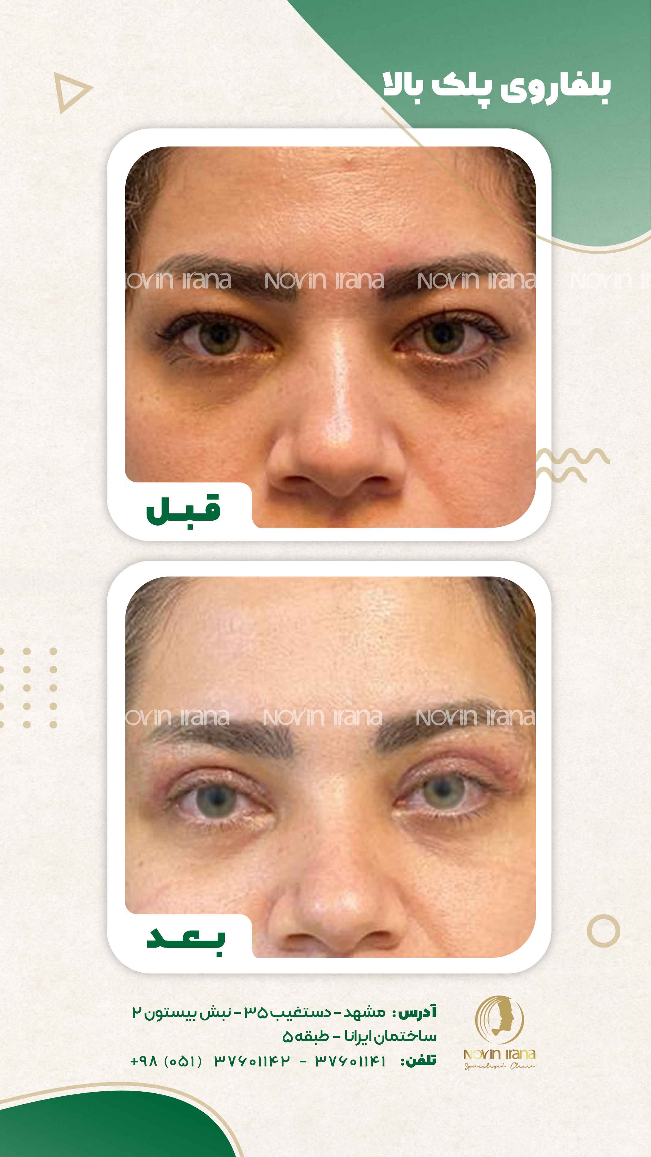 Blepharoplasty