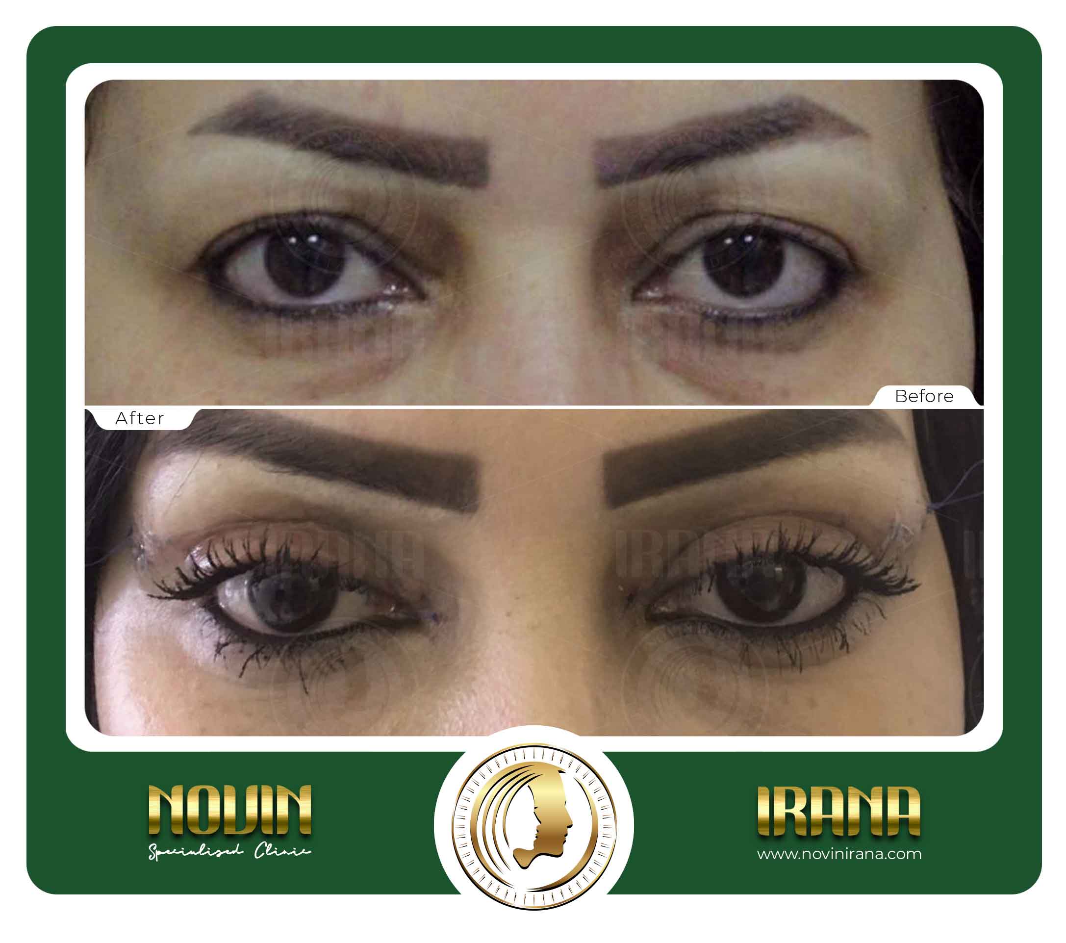 Blepharoplasty