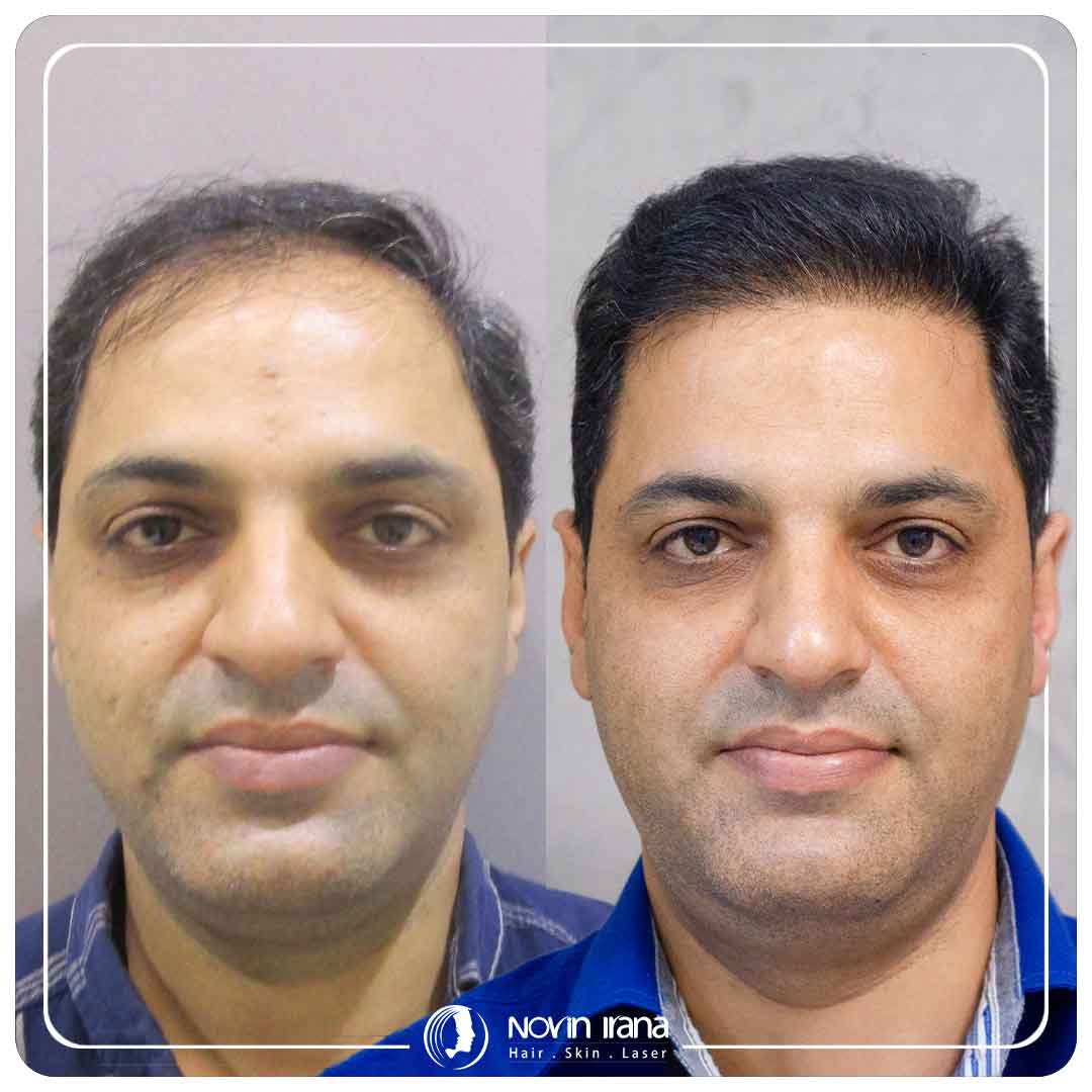 کاشت مو