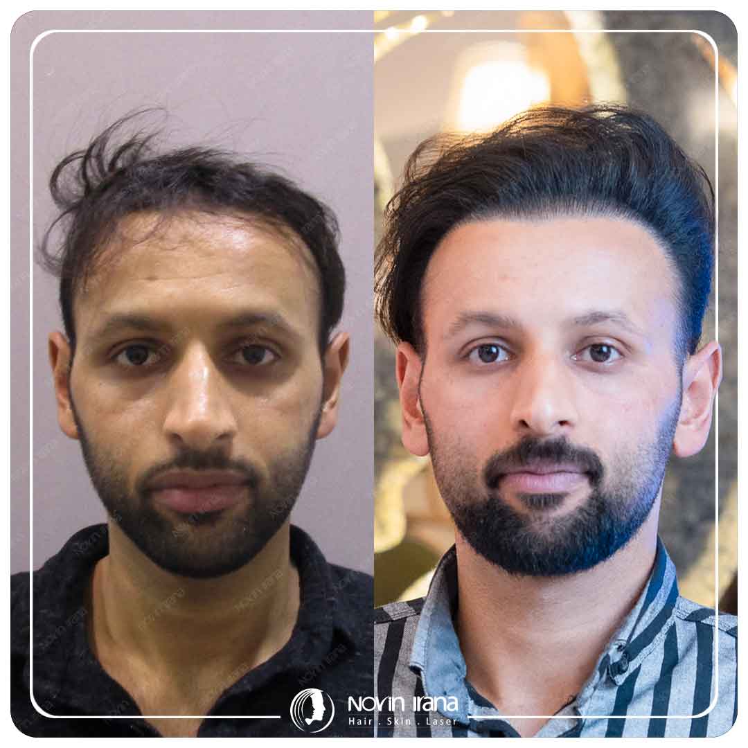 Hair Transplant