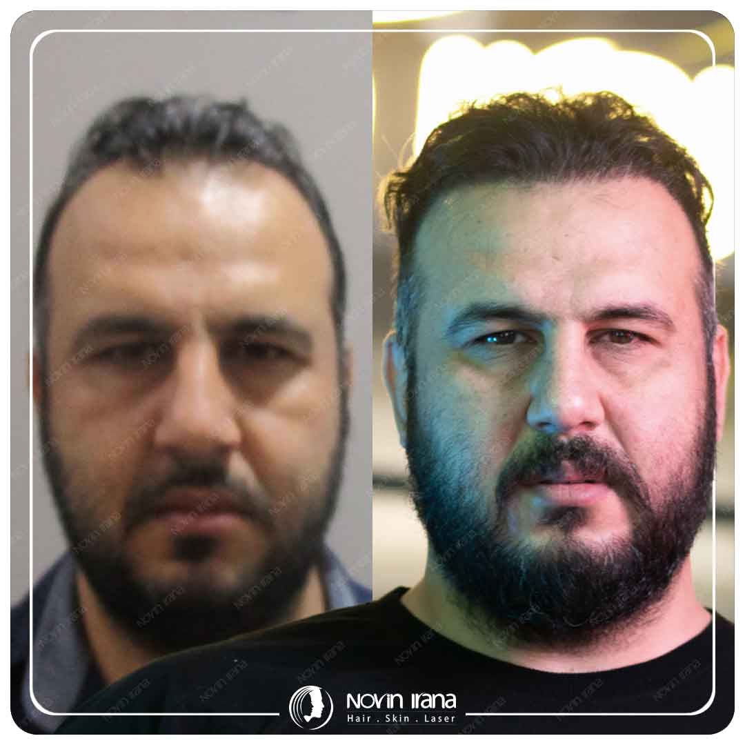Hair Transplant