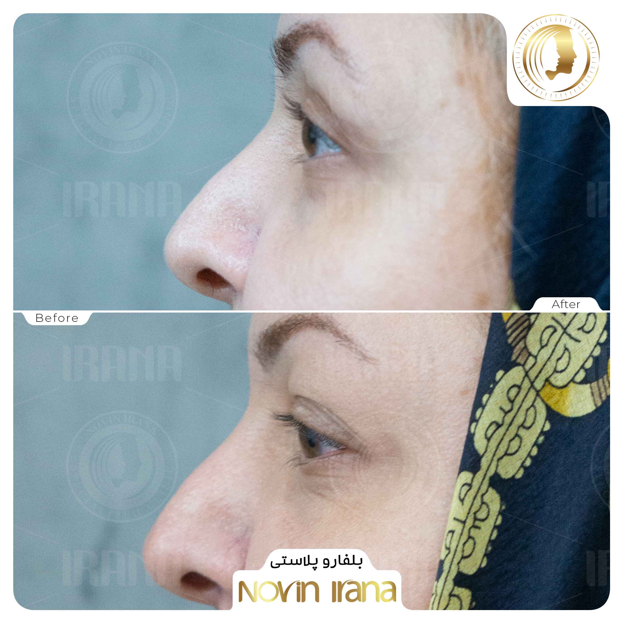 Blepharoplasty