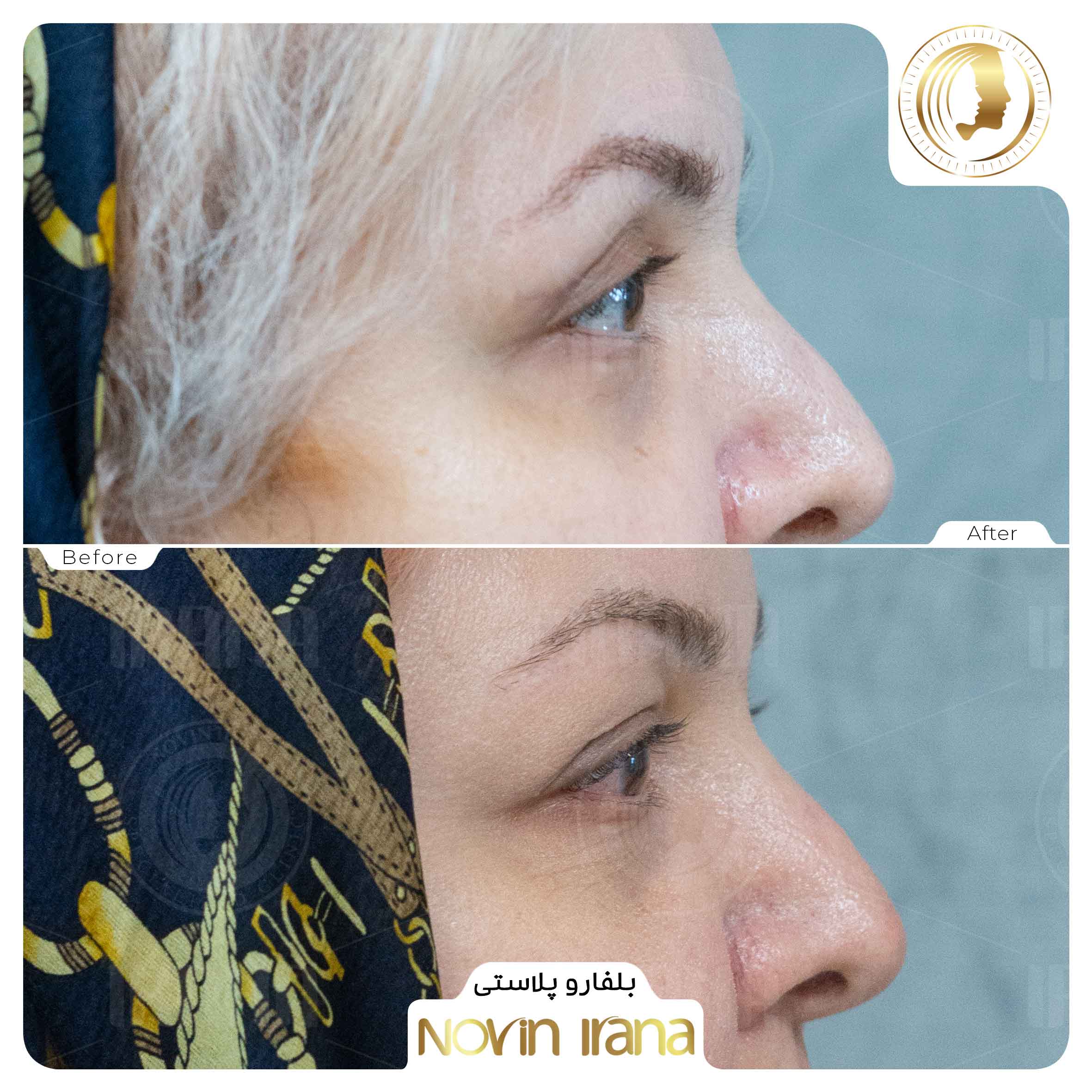 Blepharoplasty