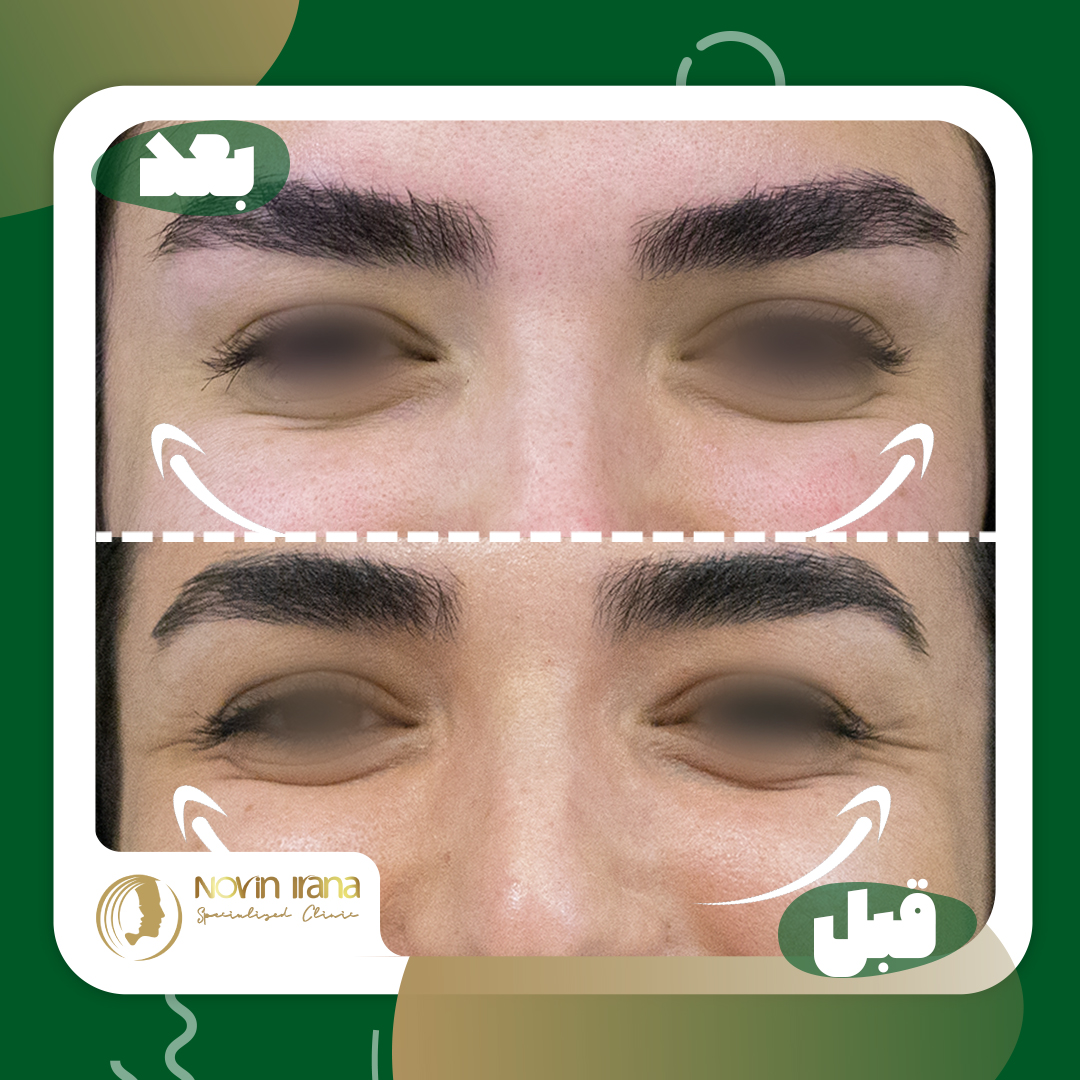 Botox
