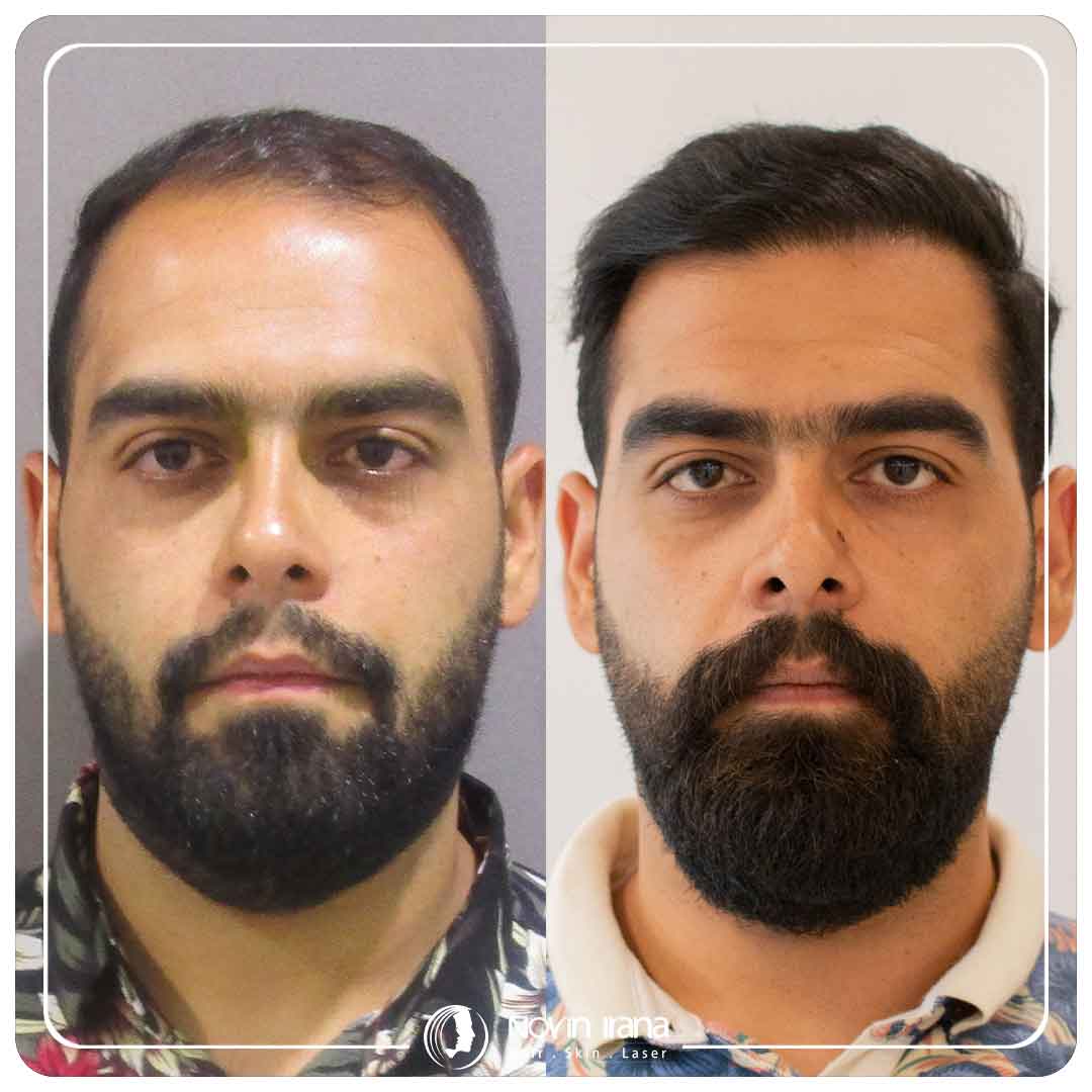 Hair Transplant