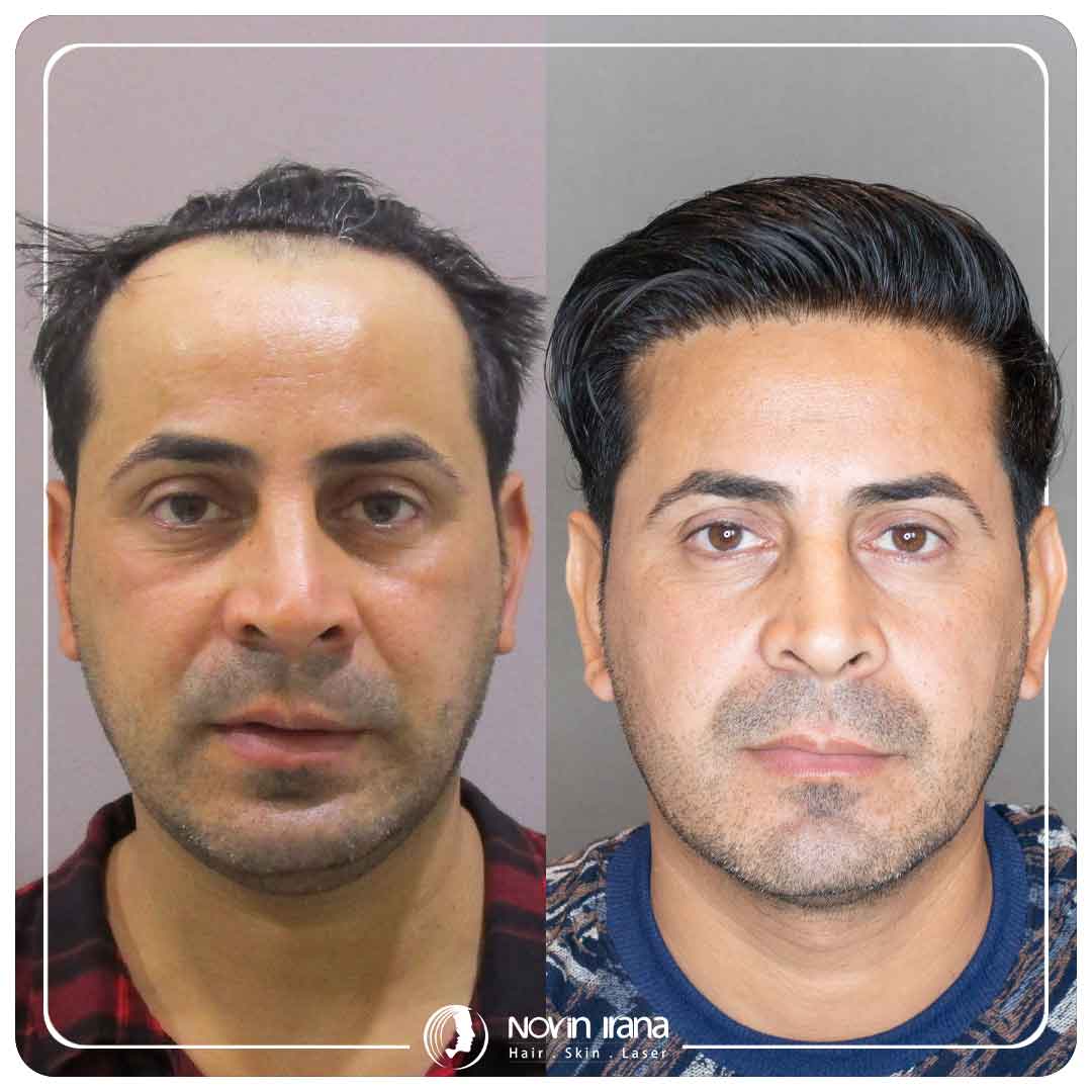 کاشت مو