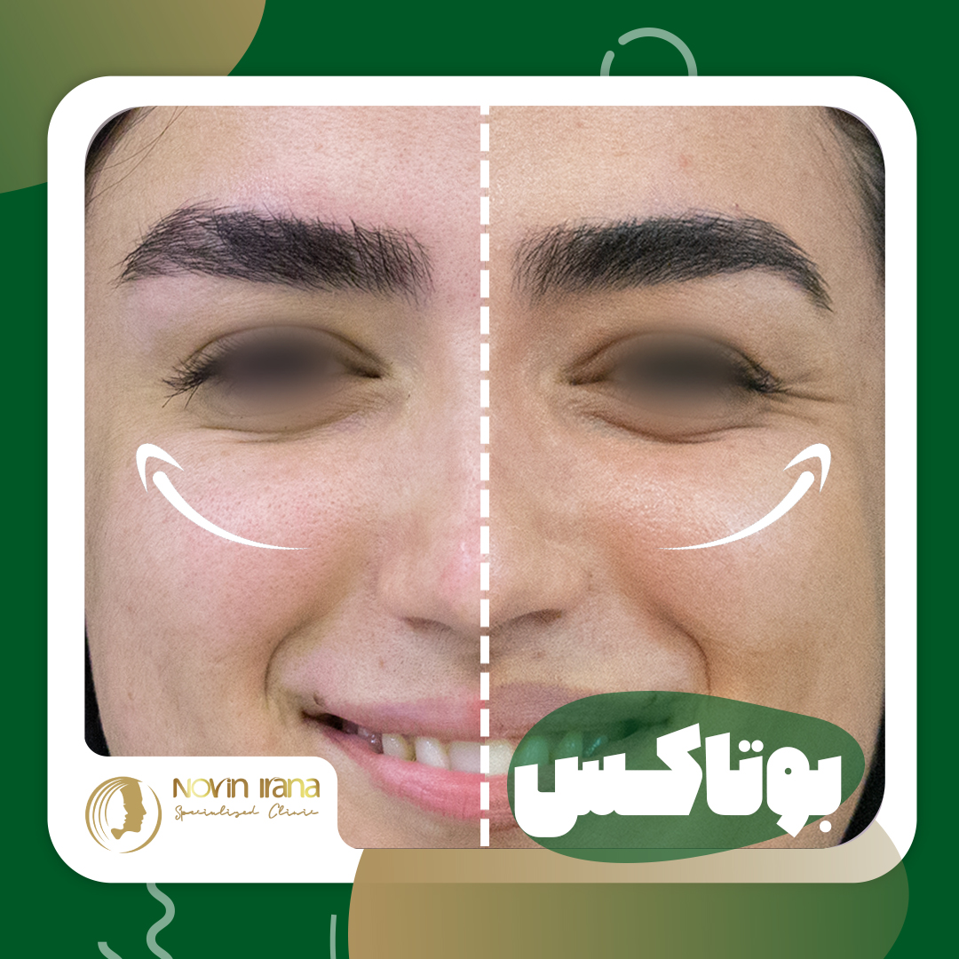 Botox