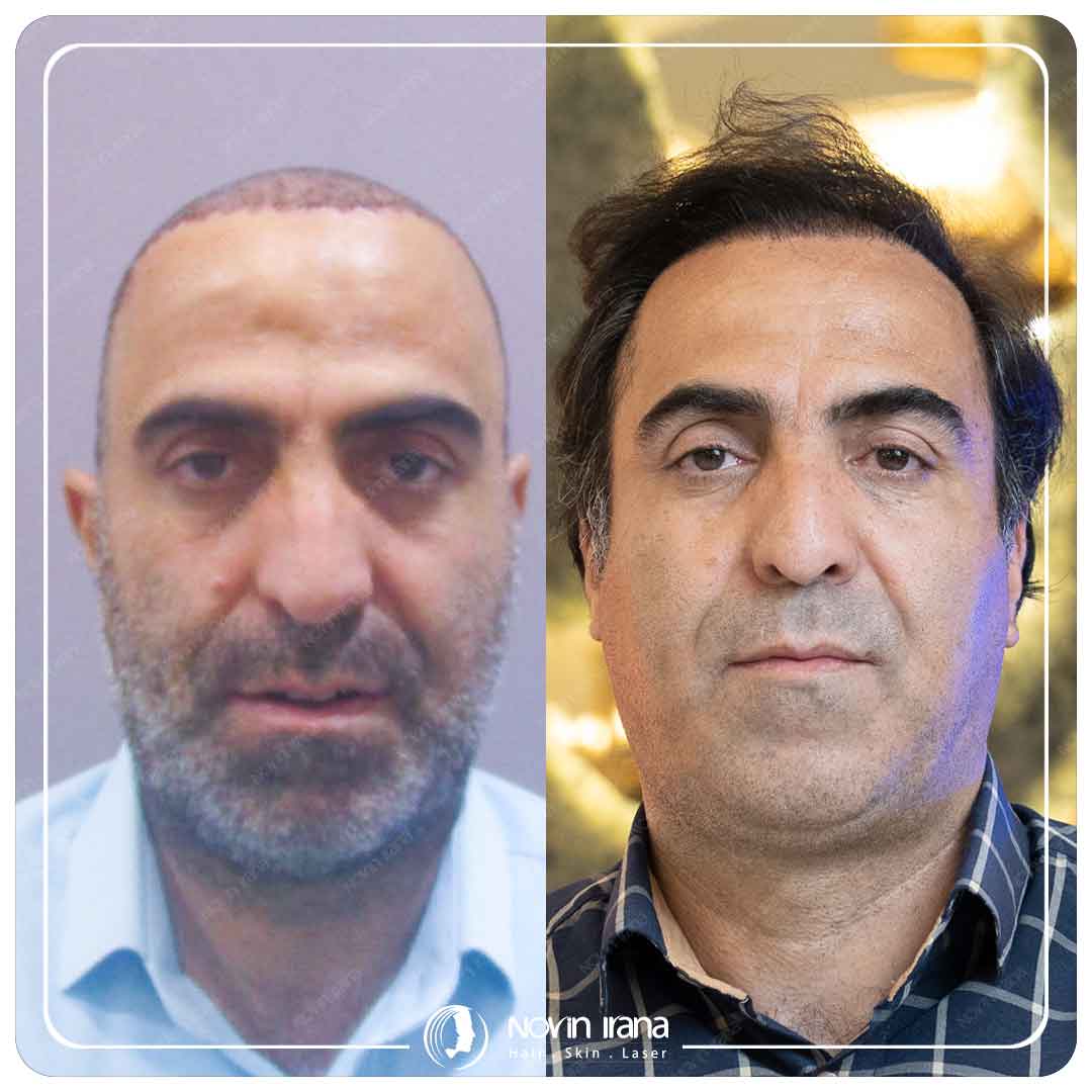 Hair Transplant