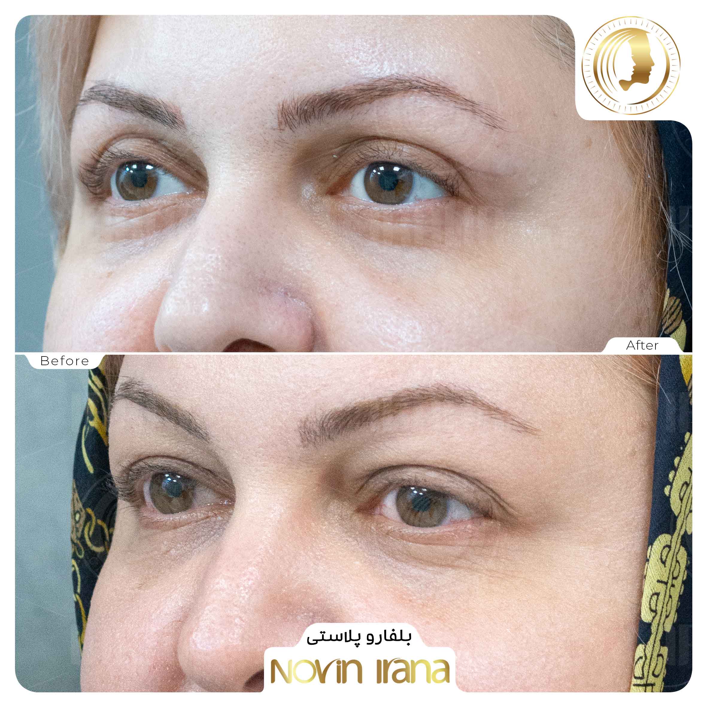 Blepharoplasty
