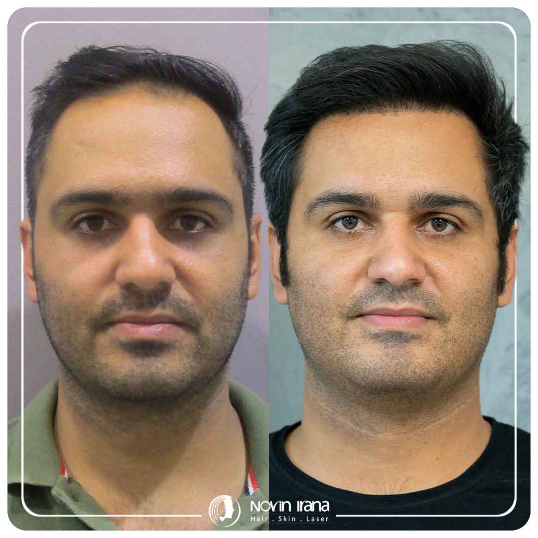 Hair Transplant