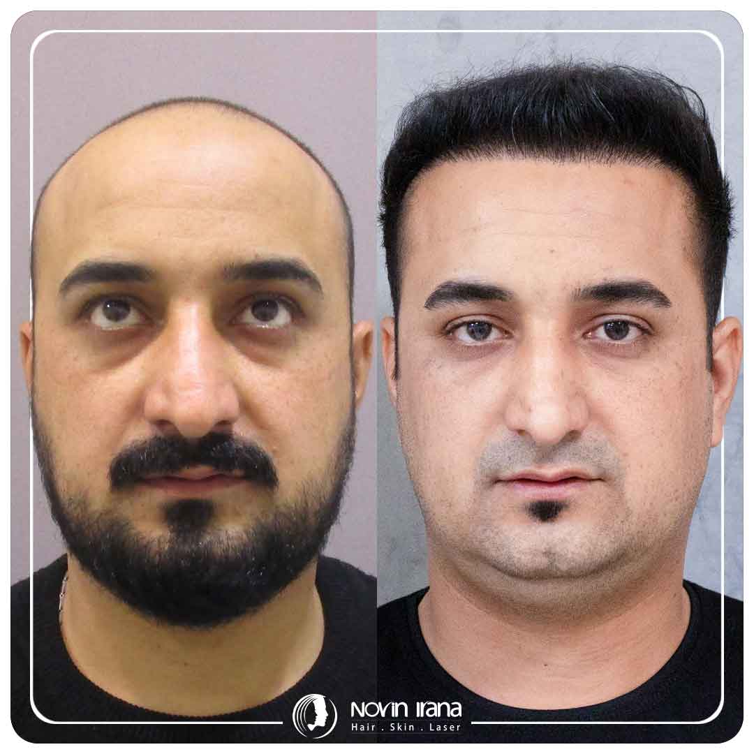 کاشت مو