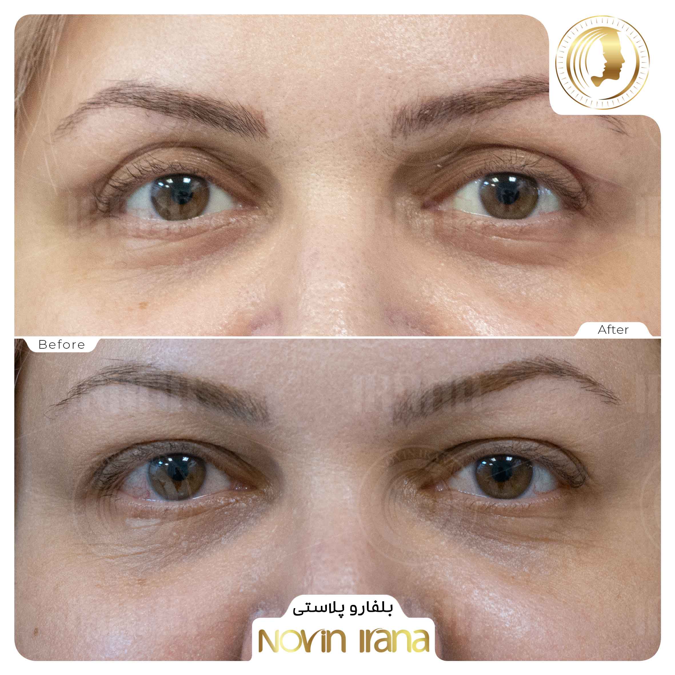Blepharoplasty